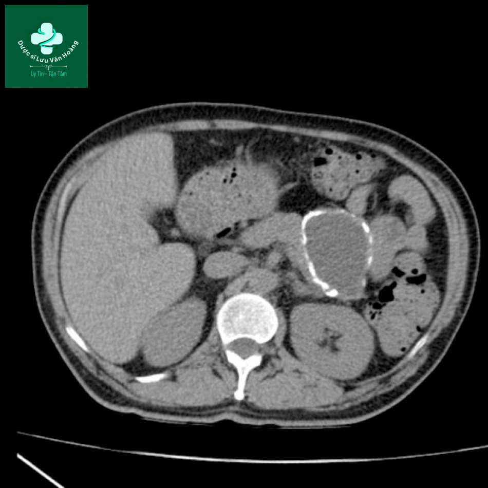 Nang giả tụy - Pancreatic pseudocysts 15 nang gia tuy 3