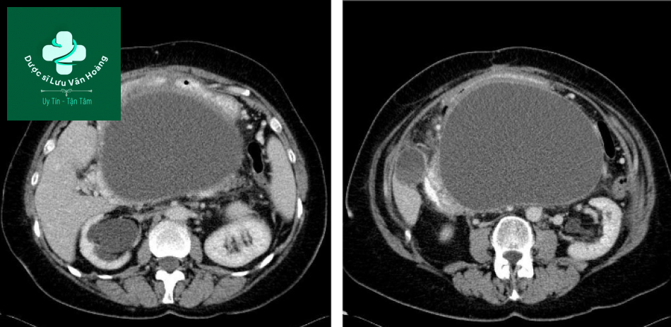 Nang giả tụy - Pancreatic pseudocysts 16 nang gia tuy 4