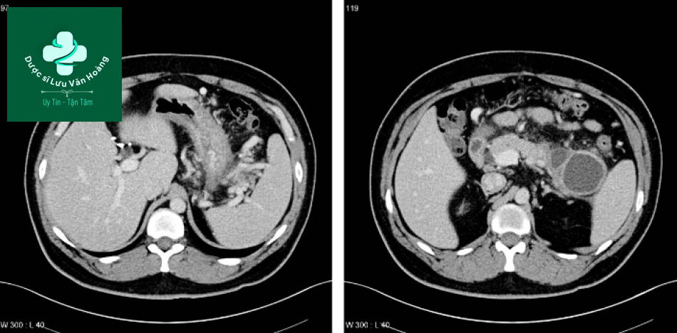 Nang giả tụy - Pancreatic pseudocysts 17 nang gia tuy 5