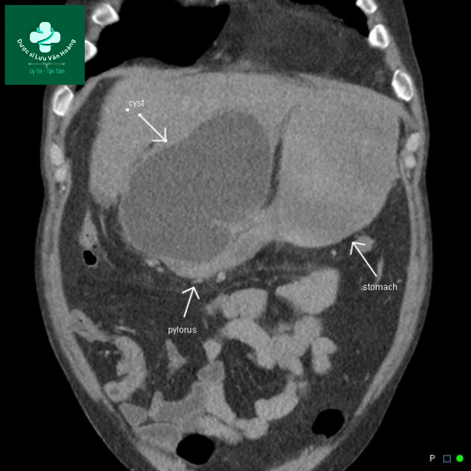 Nang giả tụy - Pancreatic pseudocysts 18 nang gia tuy 6