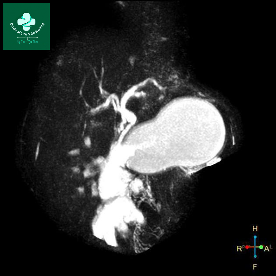 Nang giả tụy - Pancreatic pseudocysts 21 nang gia tuy 9