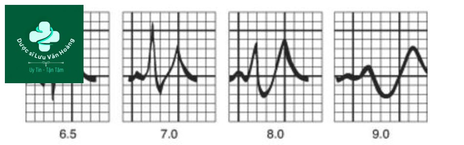 Fig. 57.2 Hyperkalemia