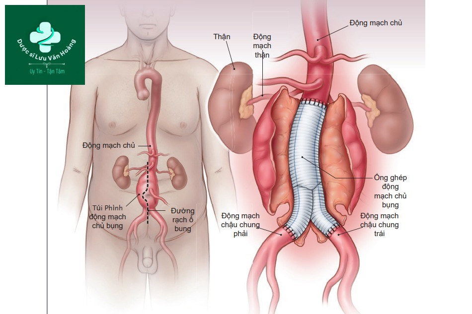 Hình 1. Can thiệp mổ mở phình động mạch chủ bụng dưới thận