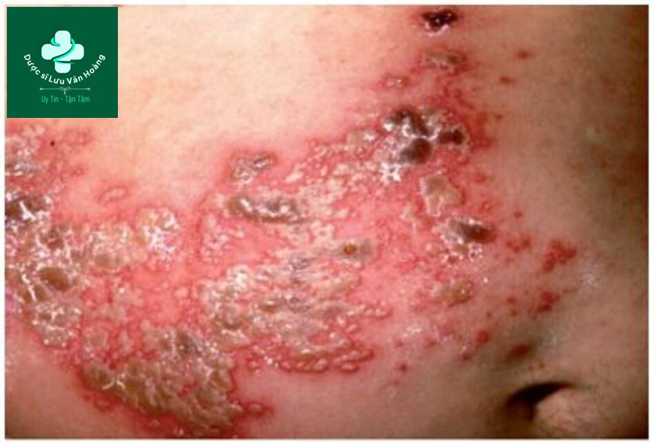 Tìm hiểu về cấu trúc và chức năng của da 27 HÌNH 2.10 Herpes zoster – sự tái hoạt của virus varicella-zoster trong các hạch thần kinh cảm giác dẫn đến phát ban da, mụn nước, đau.