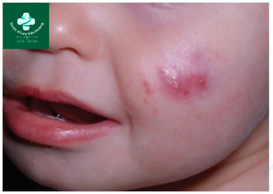 Tìm hiểu về cấu trúc và chức năng của da 30 HÌNH 2.13 Mụn trứng cá ở trẻ sơ sinh – một rối loạn phổ biến ảnh hưởng đến đơn vị nang lông tuyến bã. Androgen của mẹ có ảnh hưởng.
