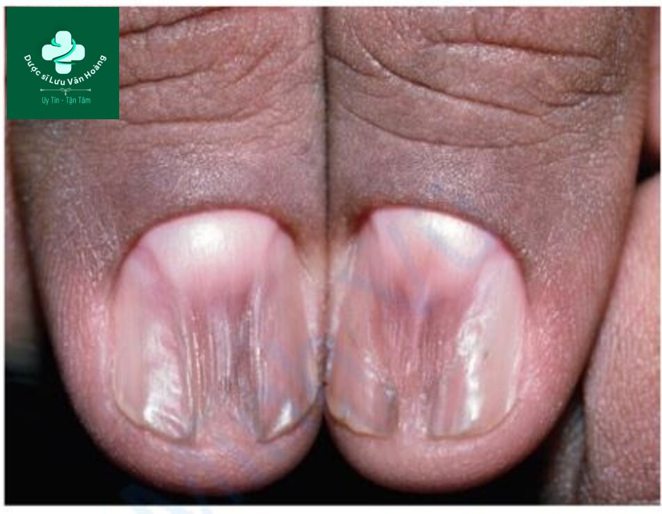 Tìm hiểu về cấu trúc và chức năng của da 32 HÌNH 2.15 Lichen phẳng – một tình trạng viêm thường ảnh hưởng đến da và niêm mạc, nhưng có thể ảnh hưởng đến chất nền của móng và gây ra tình trạng móng bị loạn dưỡng.
