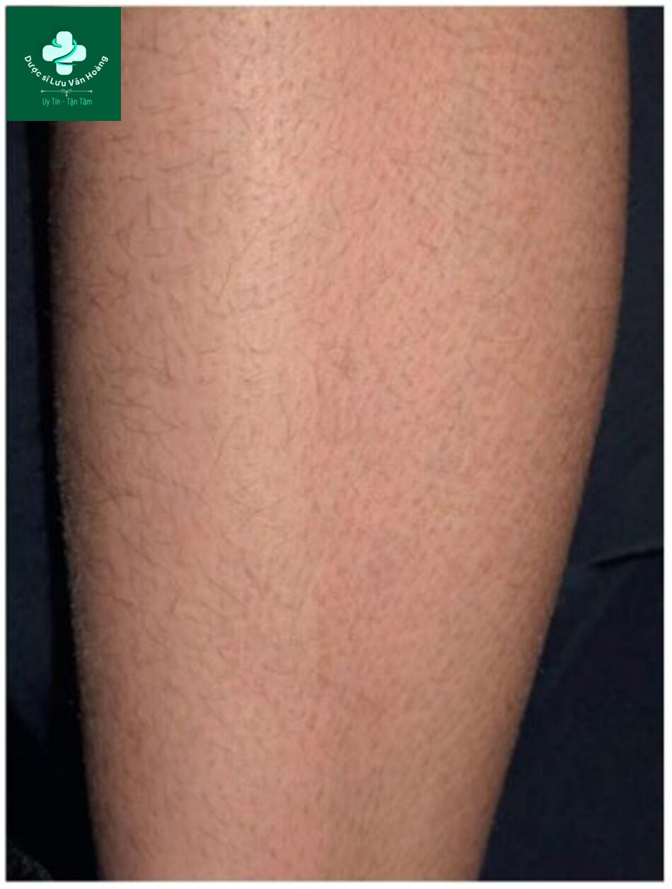 Tìm hiểu về cấu trúc và chức năng của da 20 HÌNH 2.3 Ichthyosis vulgaris - một tình trạng da khô di truyền tự miễn phổ biến thứ phát do thiếu hụt Hm88i.com Sòng bài trực tuyến filaggrin. Vảy ‘giống cá’ ở ống chân trước.
