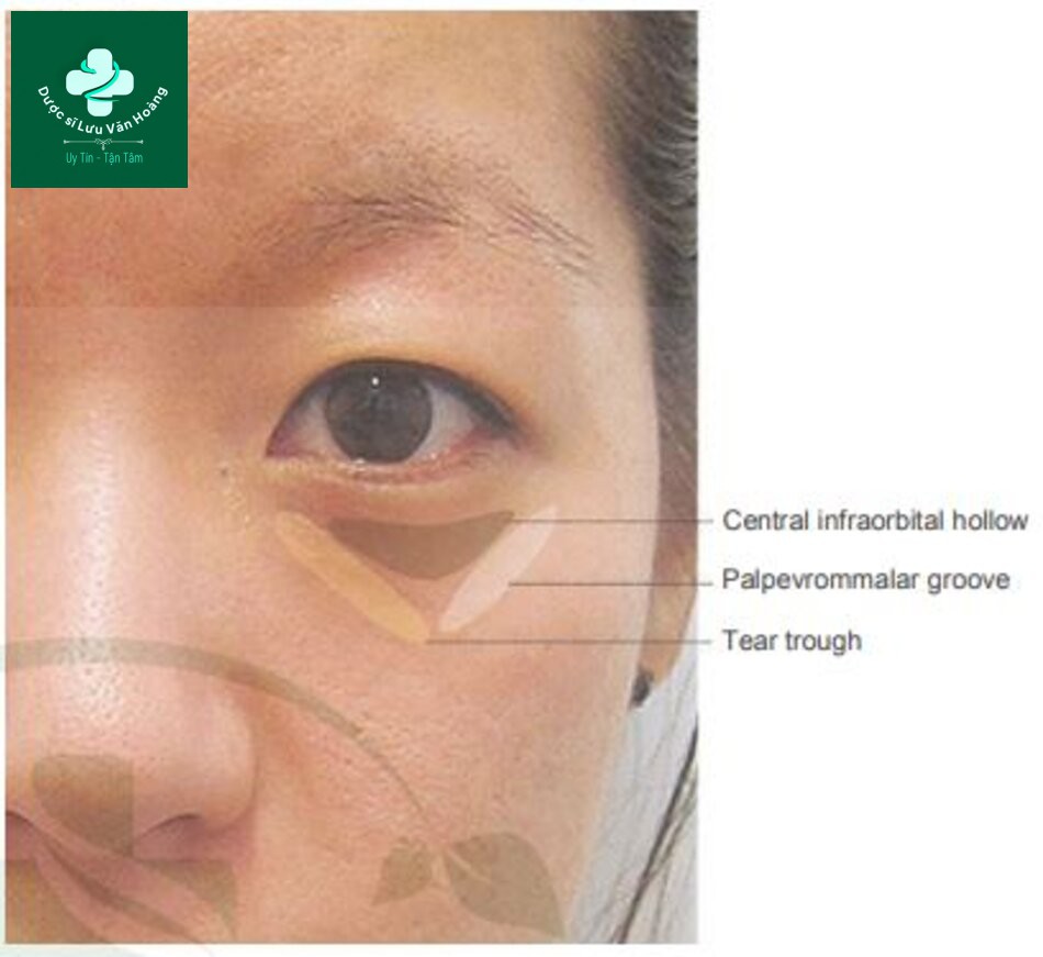 Kỹ thuật làm đầy hõm mắt dưới, rãnh nước mắt, và rãnh mí má 10 Fig. 4.32 Infraorbital hollowness consists of three parts depending on the location, namely the tear trough on the medial aspect, the central infraorbital hollow on the central aspect, and the palpebromalar groove on the lateral aspect