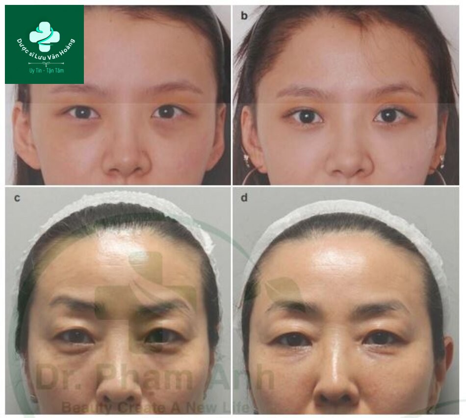 Kỹ thuật làm đầy hõm mắt dưới, rãnh nước mắt, và rãnh mí má 11 Fig. 4.33 (a) Before and (b) after tear trough volumization in a 28-year-old female. (c) Before and (d) after volumiza-tion of the tear trough, palpebromalar groove, and anterior malar depression in a 48-year-old female