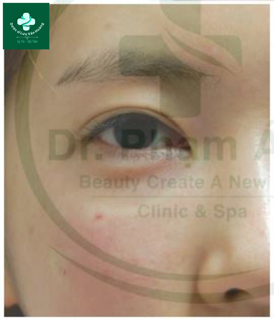 Kỹ thuật làm đầy hõm mắt dưới, rãnh nước mắt, và rãnh mí má 13 Fig. 4.35 This clinical photo well illustrates the circum-ference location of the orbital retaining ligament repre-sented in white due to the vasoconstriction induced by diffusion ofthe epinephrine mixed with lidocaine injected in the cannula entry point