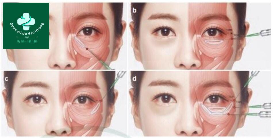 Kỹ thuật làm đầy hõm mắt dưới, rãnh nước mắt, và rãnh mí má 15 Fig. 4.37 (a) tear trough (b) central infraorbital hollow (c) palpebromalar groove, and (d)total infraorbital hollow