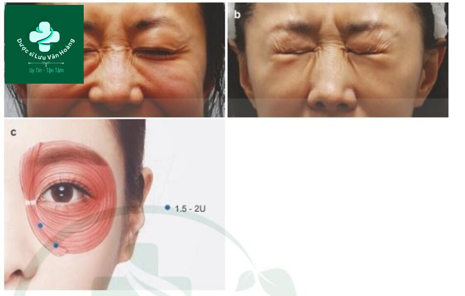 Kỹ thuật làm đầy hõm mắt dưới, rãnh nước mắt, và rãnh mí má 16 Fig. 4.38 Sử dụng botox để điều trị phì đại giải trung tâm cơ vòng mắt (a) Before, (b) afterand (c). điểm tiêm cho phì đại giải trung tâm cơ vòng mắt