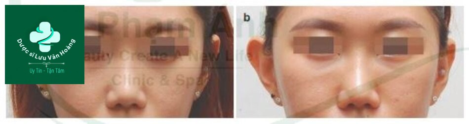 Kỹ thuật làm đầy hõm mắt dưới, rãnh nước mắt, và rãnh mí má 17 Fig 4.39 (a) Before and (b) after tear trough volumization. Chú ý tới sự lồi lõm của vùng điều trị