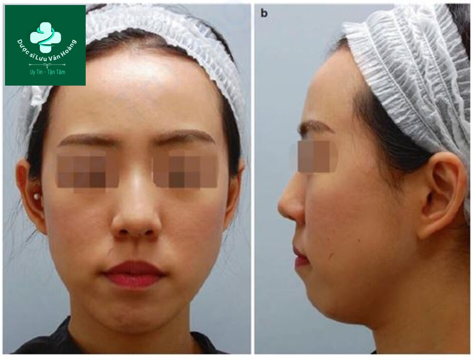 Hình 1.11 Cằm lẹm có thể được chẩn đoán chính xác hơn bằng (a) mặt trước và (b) mặt bên