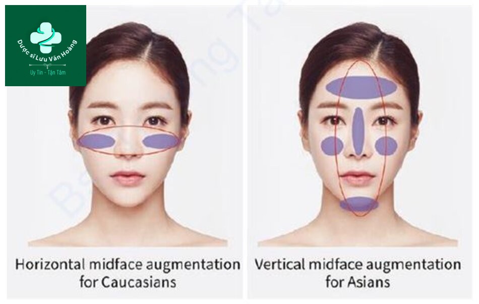 Hình 1.23 Các chiến lược khác nhau để nâng cao mặt giữa giữa người da trắng và người châu Á