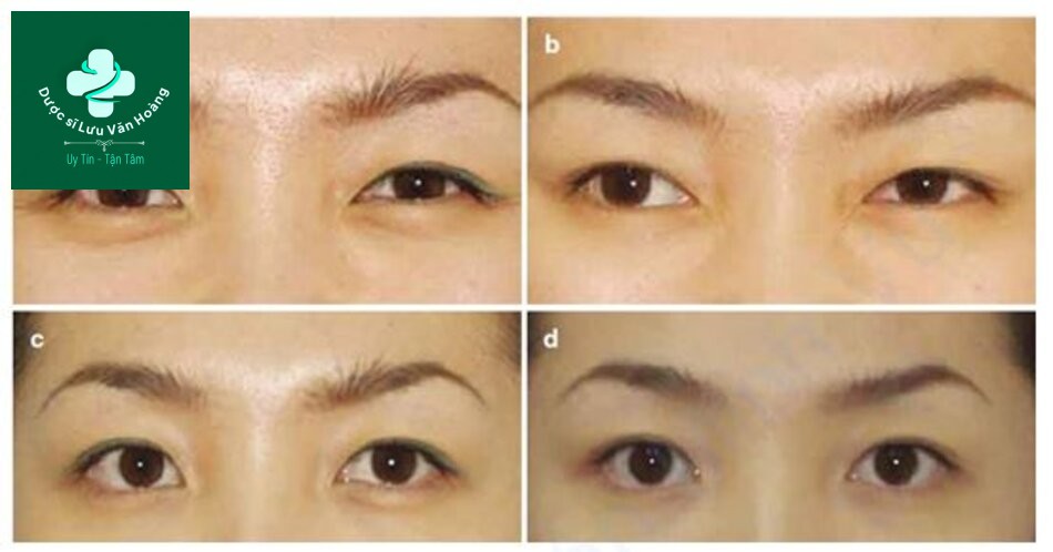 Hình 1.26 (a, c) Trước và (b, d) sau khi loại bỏ cuộn mí dưới bằng tiêm độc tố botulinum