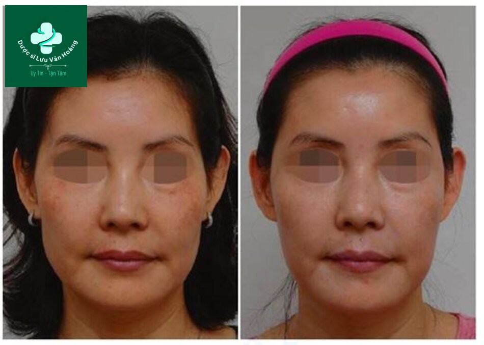 Hình 1.4 Một gò má nổi rõ có thể được ngụy trang bằng cách phục hồi thể tích đồng thời ở hõm thái dương và má bên bằng ảo ảnh quang học