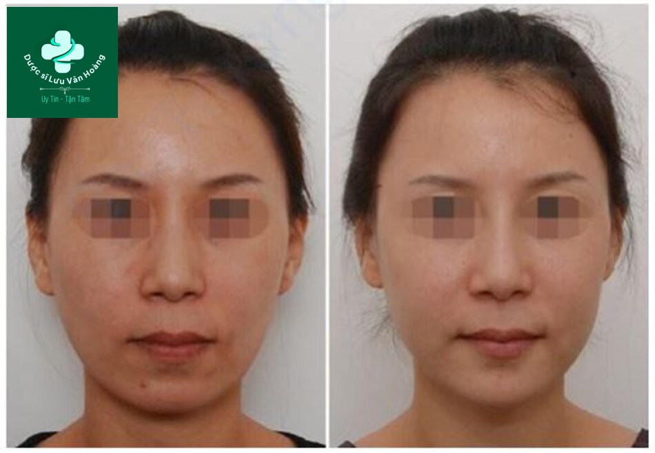 Hình 1.5 Kéo dài cằm bằng tiêm filler để mang lại dáng V-line thon gọn trên mặt chữ U.