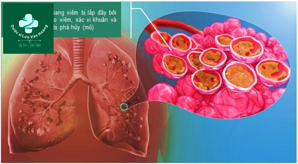 Hướng dẫn chẩn đoán và điều trị viêm phổi 42 Lấp đầy phế nang