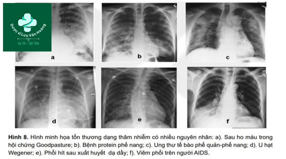 Hướng dẫn chẩn đoán và điều trị viêm phổi 52 Xquang ngực và hình ảnh mờ không đặc hiệu