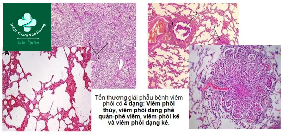 Hướng dẫn chẩn đoán và điều trị viêm phổi 44 Tổn thương giải phẫu bệnh viêm phổi có 4 dạng: Viêm phổi thùy, viêm phổi dạng phế quản-phế viêm, viêm phổi kẽ và viêm phổi dạng kê.