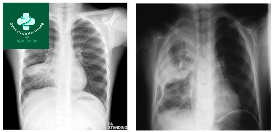 Hướng dẫn chẩn đoán và điều trị viêm phổi 48 Đông đặc phổi đồng nhất và đông đặc phổi hoại tử