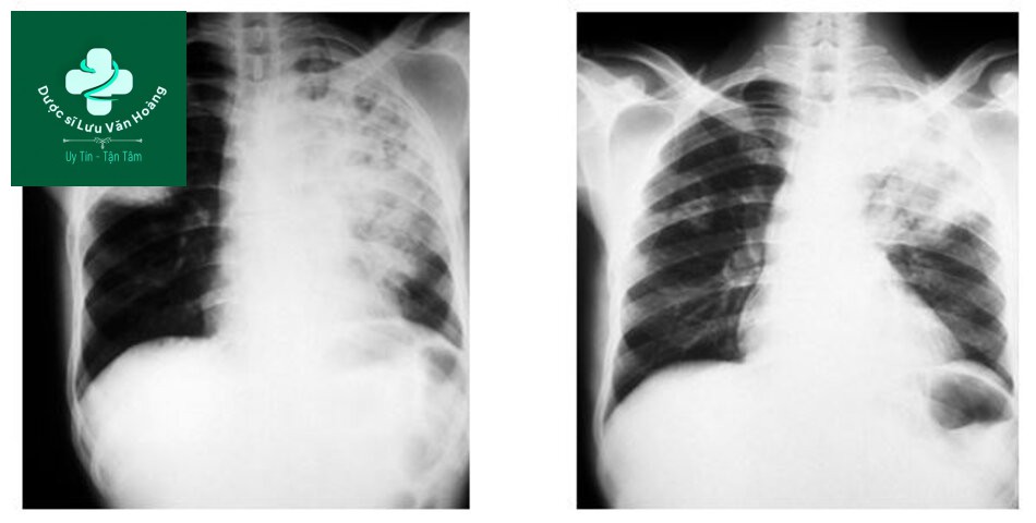 Hướng dẫn chẩn đoán và điều trị viêm phổi 49 Đông đặc phổi đồng nhất và đông đặc phổi hoại tử